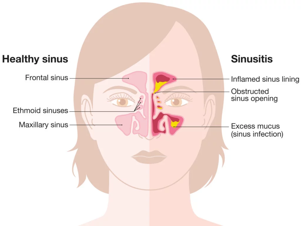 Acute Sinusitis